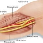 Causes of pain in the middle of the bicep and their treatment